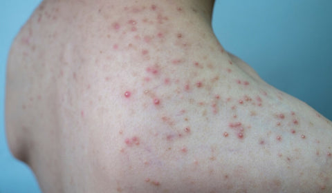 Folliculitis compared with Keratosis Pilaris