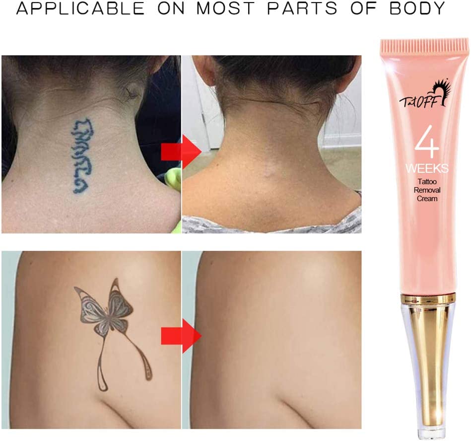 How Fast Are Laser Tattoo Removal Treatments  LaserAll