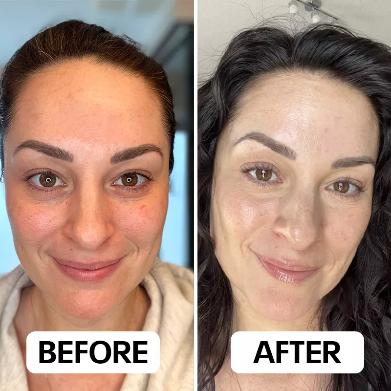 Before and after results using EyePods for under eye bags removal