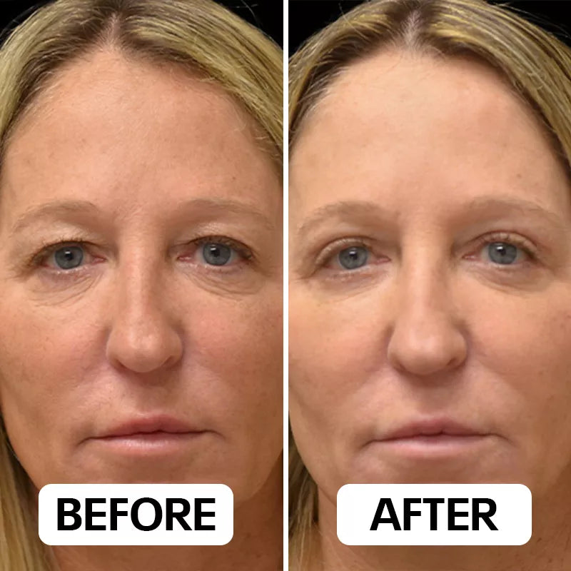 Visible changes after using EyePods under eye wrinkle treatment