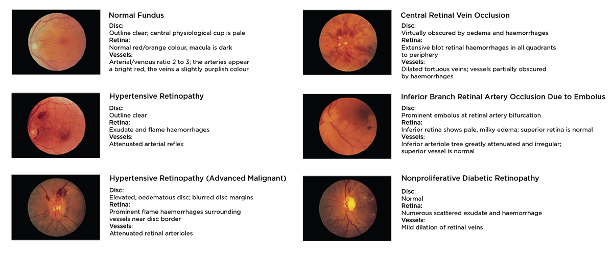 Common Pathologies of the Eye