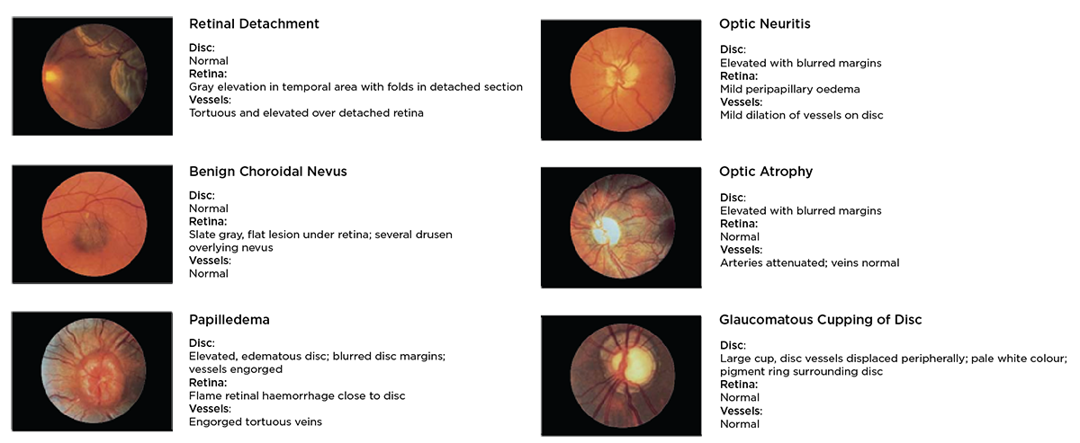 Common Pathologies of the Eye