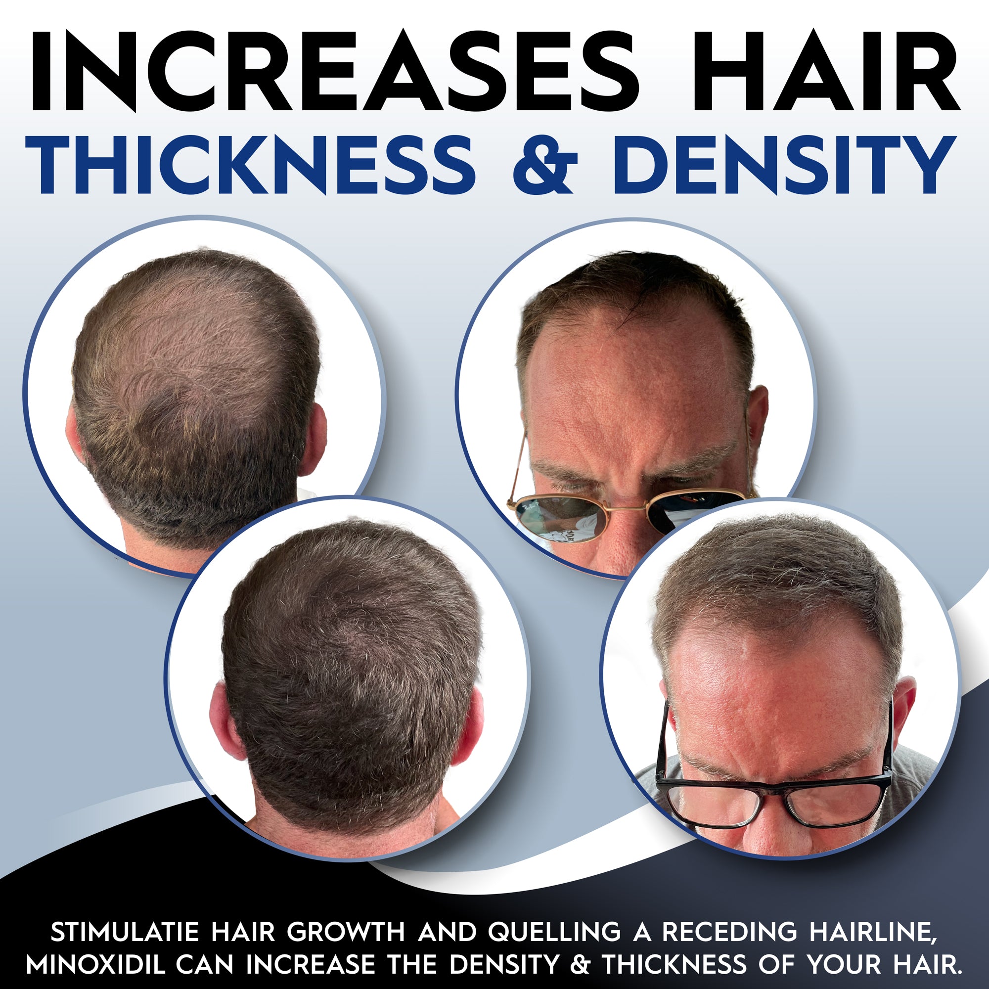 5 Minoxidil Hair Regrowth Foam Treatment for Male Anti Hair Loss Hair  Growing  eBay