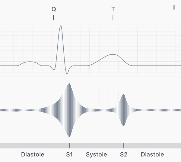 Normal heart sound + simplified PCG with S2 annotated