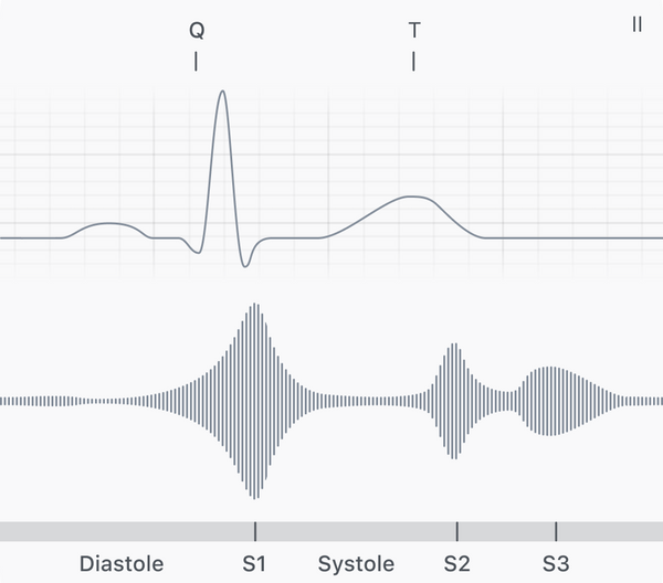 S3 audio + ECG