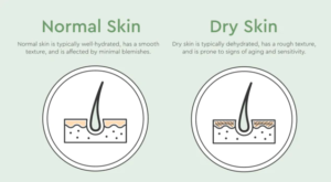 Normal vs dry skin (image courtesy: https://www.bioclarity.com/blogs/clear-skin/does-dry-skin-cause-acne-what-causes-dry-skin)
