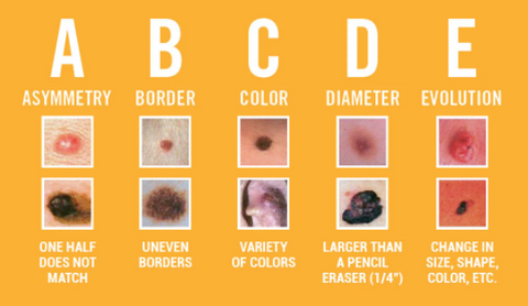 Skin Cancer ABCDE's to assess your skin - The Zealios Blog