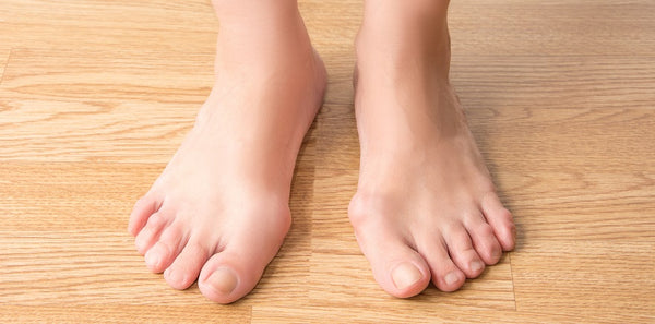 Shoe Inserts and Orthotics for Bunions 