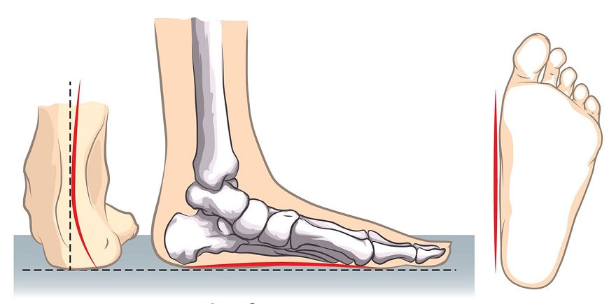 Fallen Arches Insoles - Support Reduces 