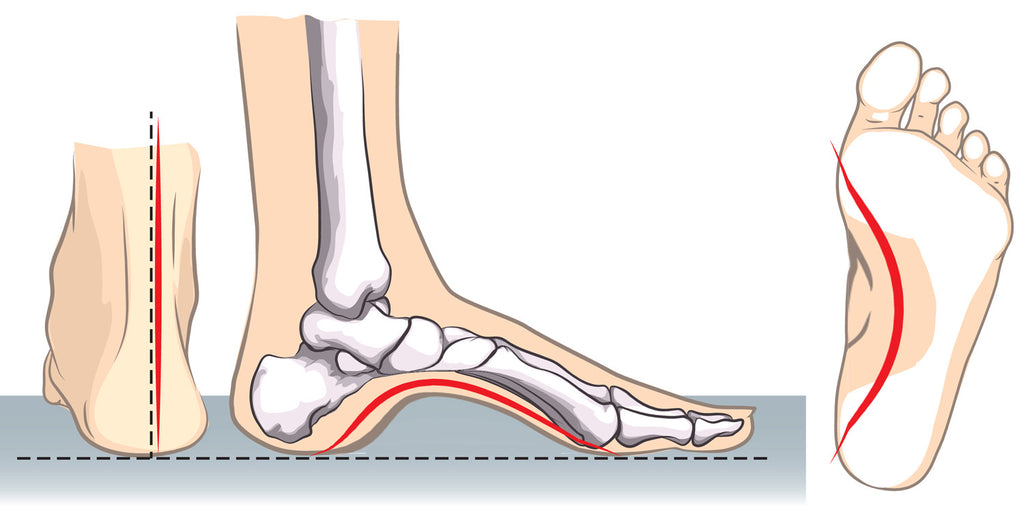 High Arch Foot Problems - Relieve Pain In Arch Of Foot - Tread Labs