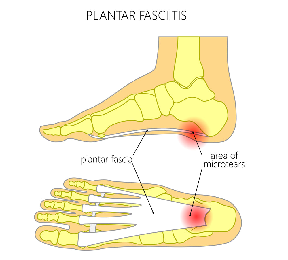 Taping For Plantar Fasciitis Diagram