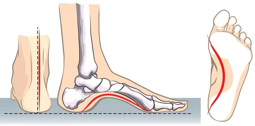 Diagram showing a high arched foot from the side view and from the bottom view.