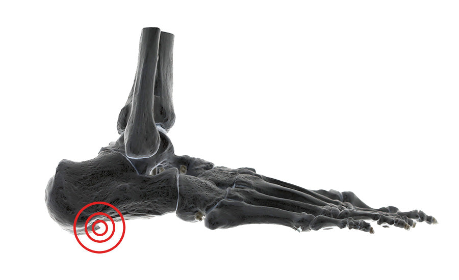 Black and white image of the bones in a foot with a red bullseye on the front bottom of the heel.