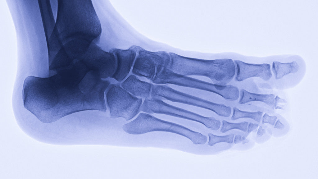 Stress fracture in feet