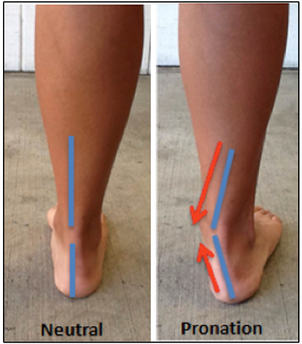 comparison of ankle inclination in neutral vs. overpronated foot