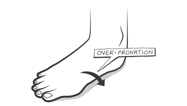 illustration showing overpronation