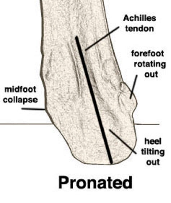 right foot rolled inward due to pronation