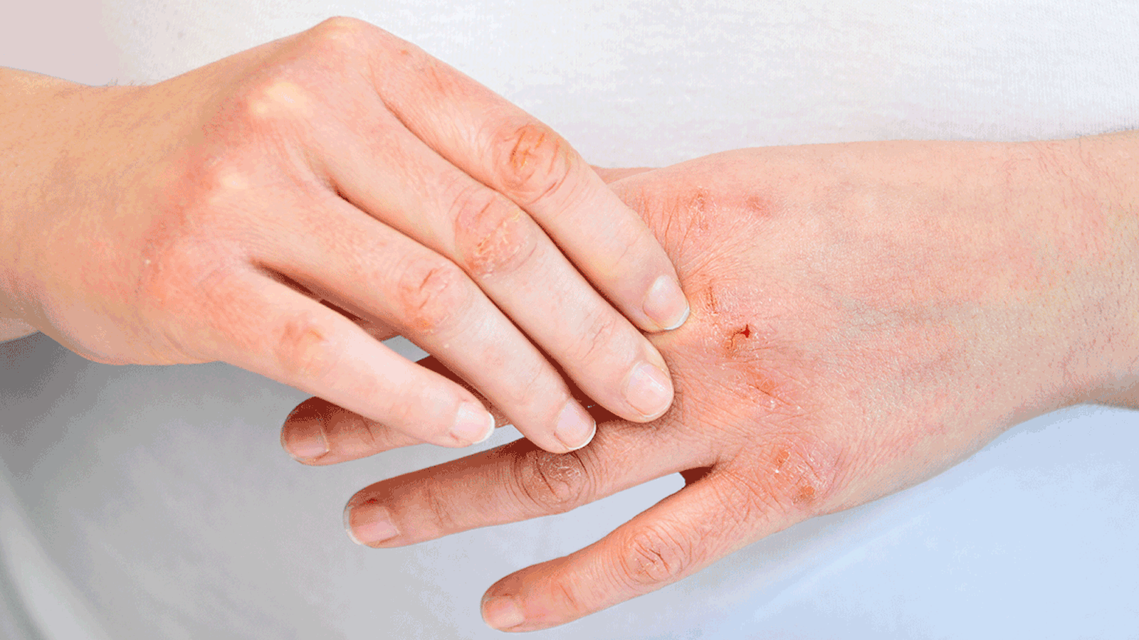The image shows two hands, one hand gently resting on top of the other. The hand underneath exhibits several areas of inflamed skin, with visible redness and lesions