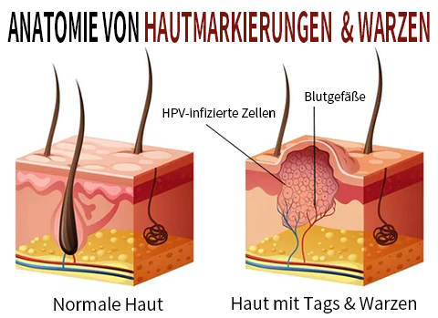 Warebrill™ Etiketten-und Muttermale-Entferner