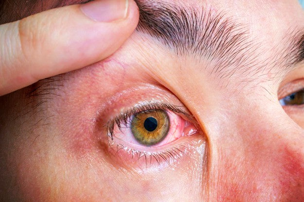 Dry Eyes | Most Common Symptoms of Hyperthyroidism