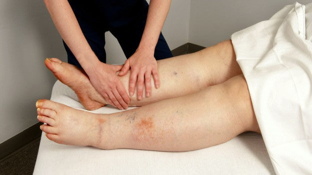 What is Lymphedema and What to Do With It | Essential Lymphedema Treatment Guide