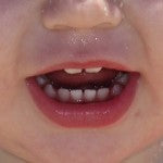 baby teeth