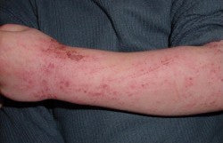 Neurodermitis am Arm eines 5-jährigen Kindes