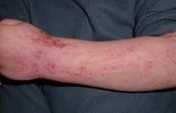 Atopic dermatitis on the arm of a 5-year-old child