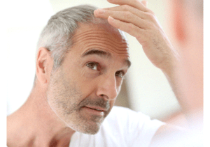 how hair loss progresses in men and women