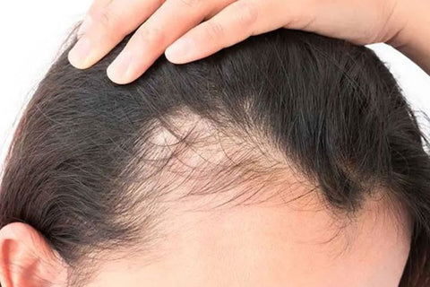 hair loss in women