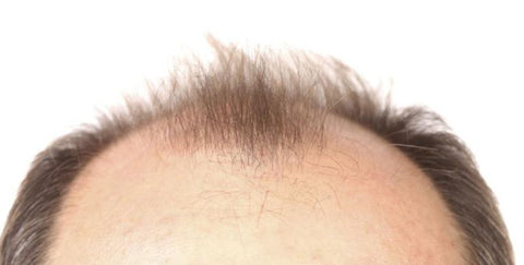 male hair pattern baldness