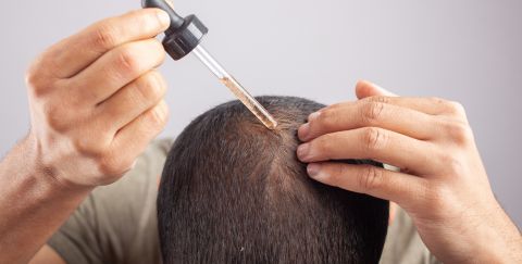 Minoxidil as hair transplant alternative