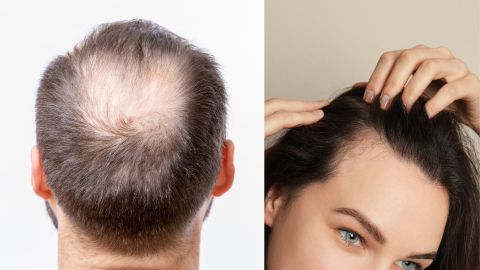 male vs female balding