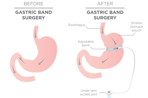 Gastric Band Expected Weight Loss