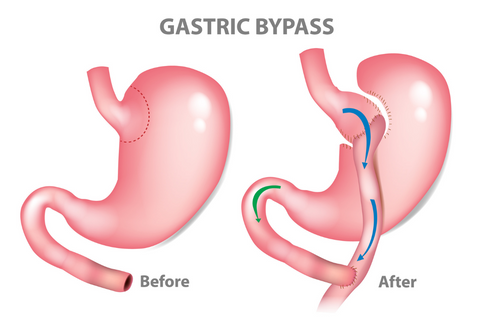 Gastric Bypass Expected Weight Loss