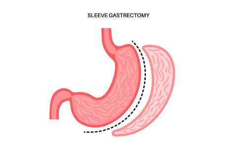 Gastric sleeve late complication
