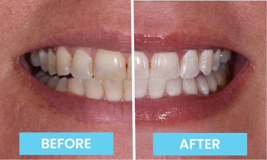 Emily Before and After