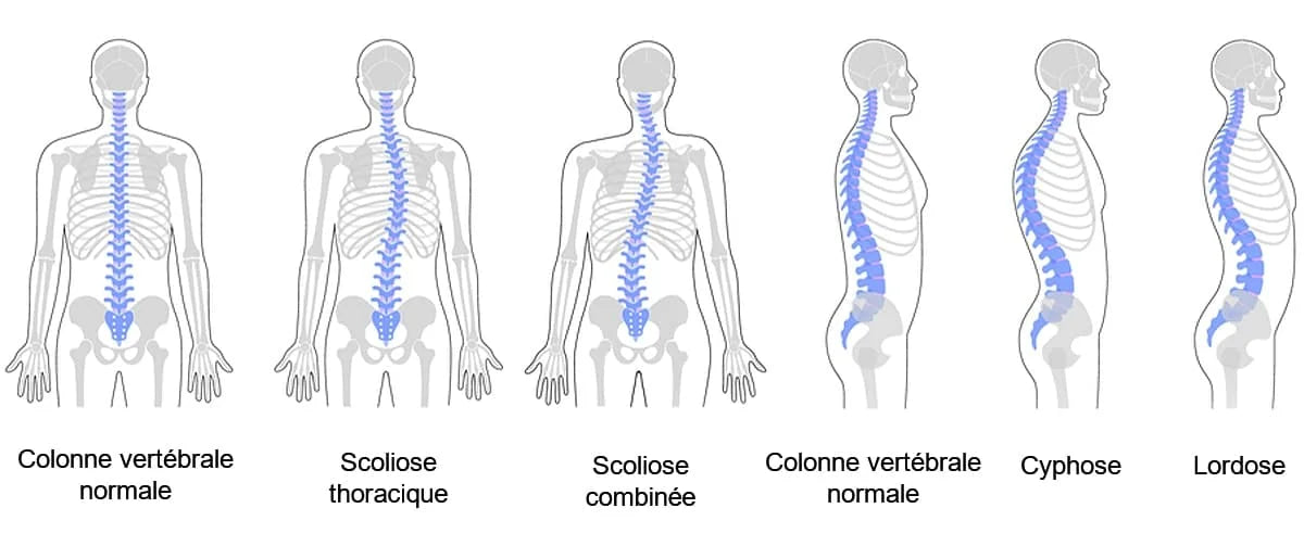 Les differents types de scoliose