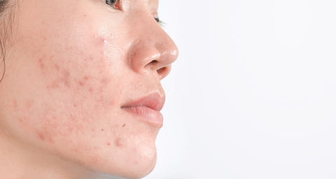 acne scar