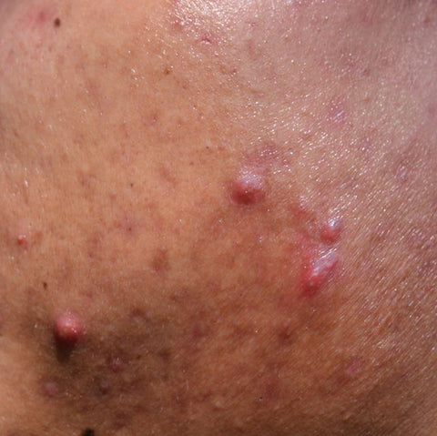 Hypertrophic Acne Scarring