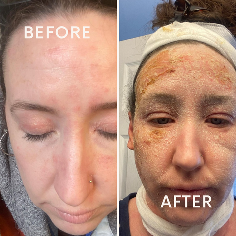 Topical Steroid Withdrawal Is 100% Preventable with before and after pictures