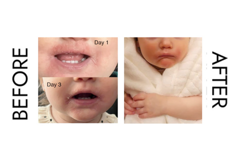 before and after eczema with tallow