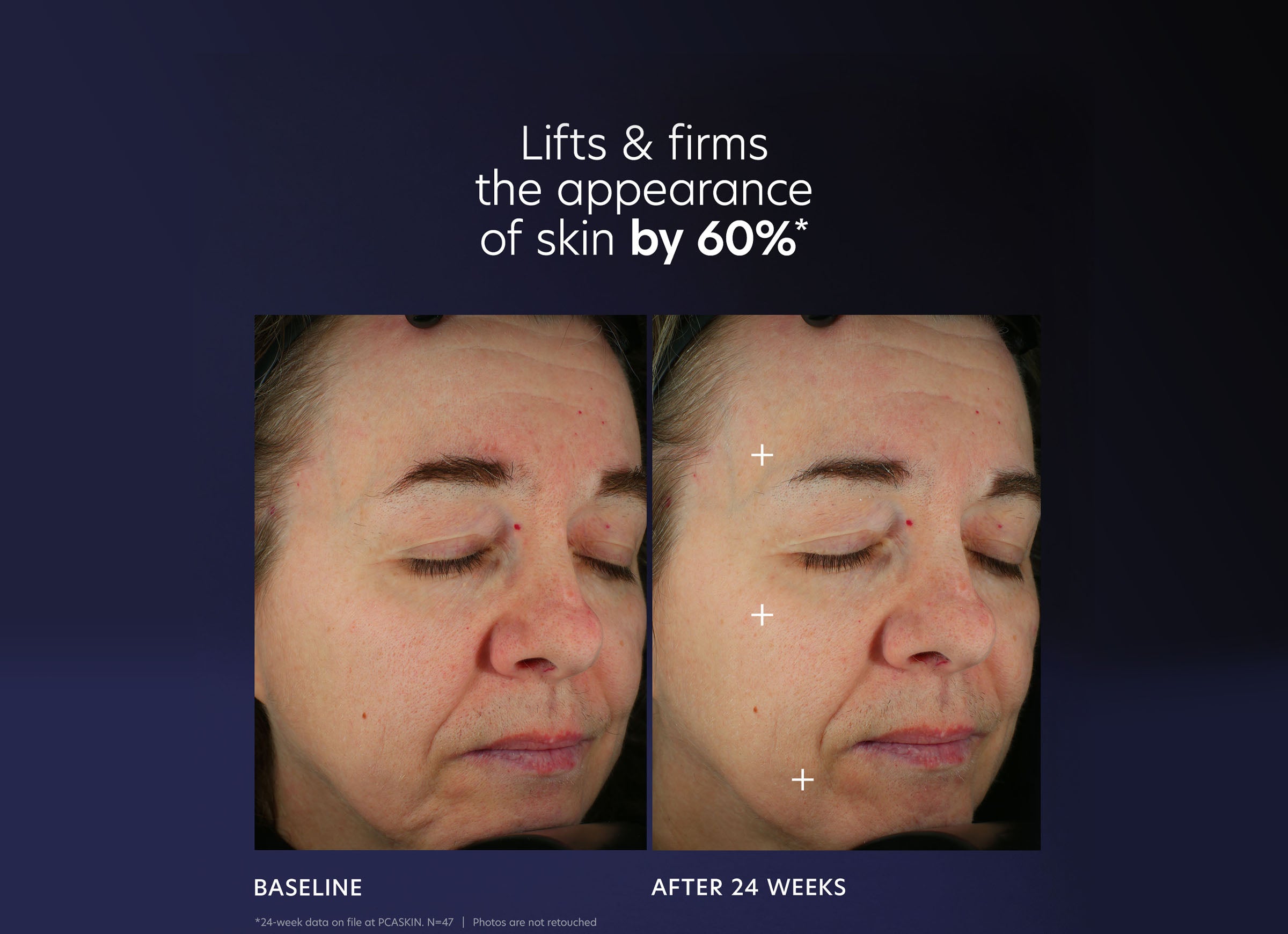 Pro-Max Age Renewal. B&A. 60% Lifts and firms 