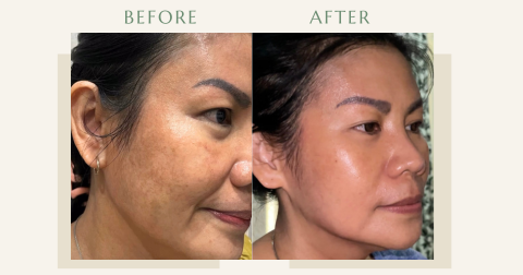 Before and after pigmentation