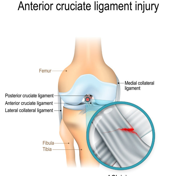 What's ACL injuries