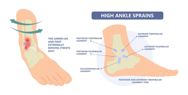 what is the high ankle sprain
