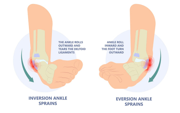 two type of ankle sprain