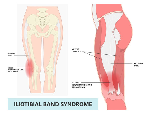 What's IT band syndorme (runner's knee)