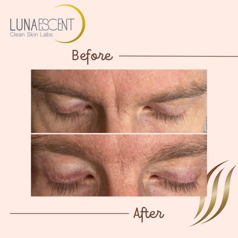 Frown Lines - Before and After facial massage with LUNAESCENT
