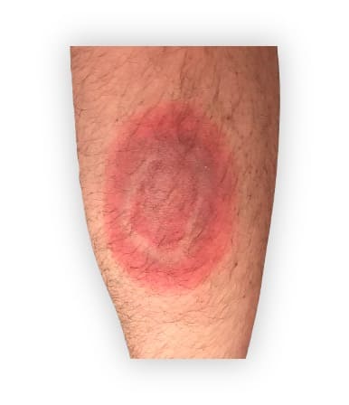 Erythema migrans (Lyme borreliose)